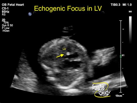 lv echogenic focus|echogenic intracardiac focus.